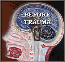 Head Before Trauma