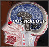 Contracoup