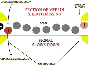 Mising Myelin Sheath